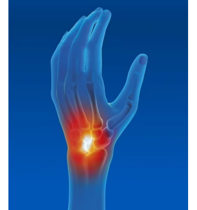 Attelle d'immobilisation du poignet Epitact