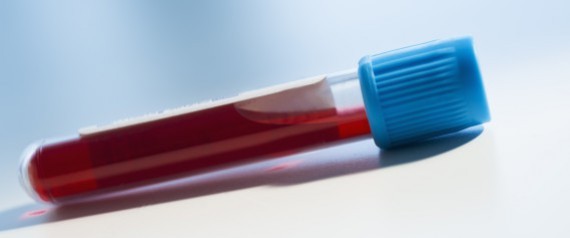 Alzheimer : un test sanguin pour détecter la maladie