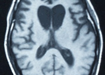Alzheimer : Nouvelle technique de diagnostic 