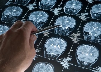 Maladie d'Alzheimer : existe t-il une forme de transmission ?